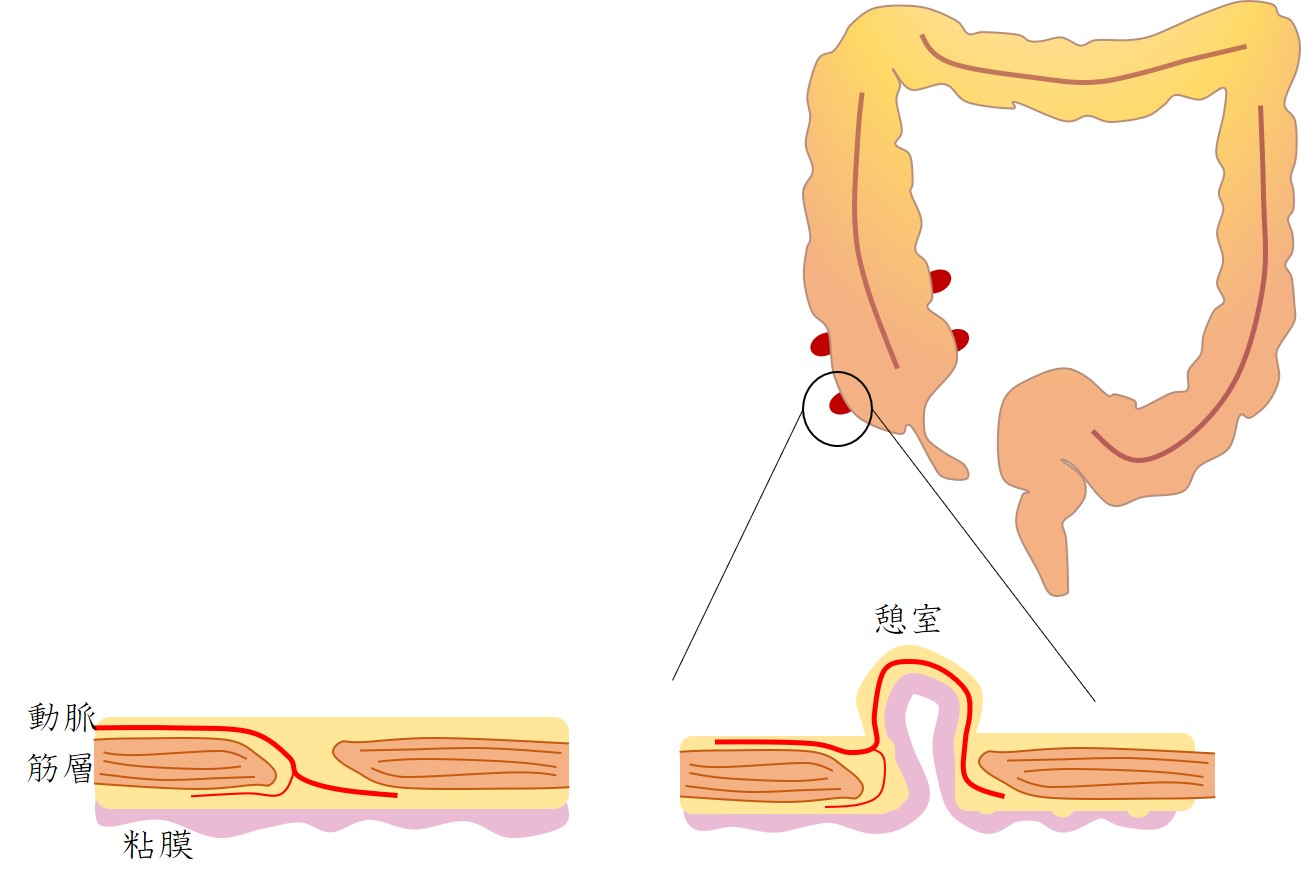 クローン病と憩室炎の違い